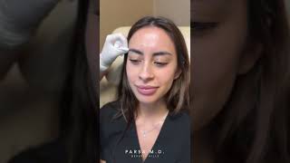 Baby Botox for Brow Lift and Smooth Forehead at Parsa MD