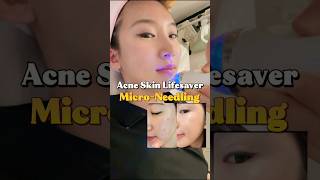 🤭Remove acne? so easy ! ✨ #acneskin #fyp #microneedling #mts #acneskin #medspalife #vlog