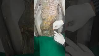 Midinguinal Point II Surface Marking