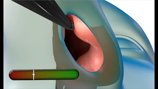 Vivaer: non-surgical procedure to help nasal congestion