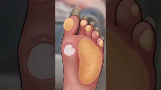 Remove fungal infection in armpit #asmr #brainasmr #makeupanimation