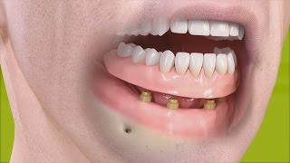 Straumann - Herausnehmbare Prothese mit Retentionsverankerung
