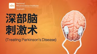 深部脑刺激术（DBS）
