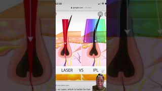 Why I don't recommend Home IPL lasers if you have dark skin