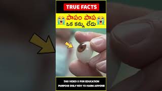 Doctor makes 3d eye for girl #factsintelugu 😭పాపం పాప😭 #amazingfacts #truefacts #shorts