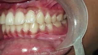 "Zero Cavities, Zero Tartar – 100% Clean Teeth 😍" #perfect #best #whiteteeth #aesthetic #latest
