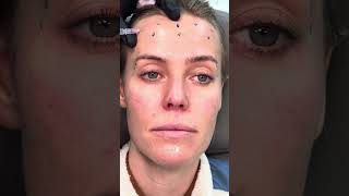 Botox Technique for 3 Areas: Dr. Somji’s Expert Injection Without Dropping Eyebrows!