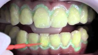 In - Office Dental Whitening Total Blanc H35