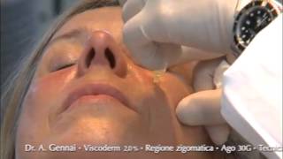 Aplicación VISCODERM 2.0% en Mejilla. Dr. Alessandro Gennai