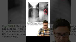 Nelson images#21 #neetss #Pediatrics