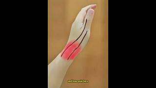 De Quervain's Tenosynovitis: Quick Fix in 5 Steps! #shorts
