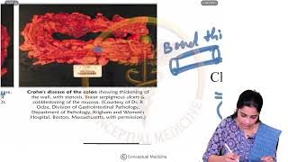 炎症性腸疾患（IBD） | USMLE Step 2 CK | 高収益内科・消化器内科