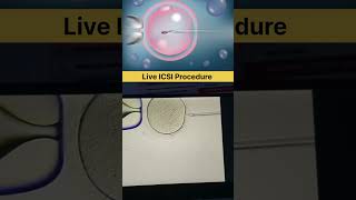 Live ICSI Procedure #ivf #icsi #ivfjourney #ivfsuccess #embryology #maleinfertility #lowspermcount