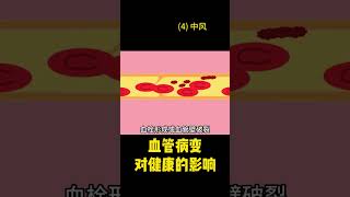 [101]血管病变会对身体健康造成什么影响？(4) 中风