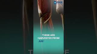 Your Guide to Ligament Choices for ACL Surgery