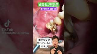 まっぷたつの歯🦷#虫歯 #歯根破折 #歯が欠けた #歯が割れた #治療 #根管治療 #おすすめ #口腔外科 #抜歯 #歯医者 #歯根嚢胞