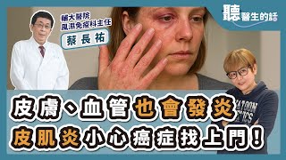 '25.04.02【愛健康│聽醫生的話】蔡長祐醫師談「皮膚、血管也會發炎 皮肌炎小心癌症找上門！」