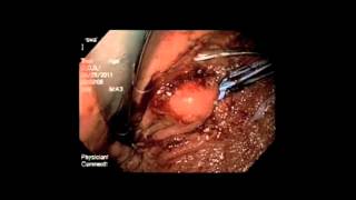 Endoluminal Stomach-Sparing Resection of Gastric Gists
