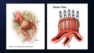 Pterional Craniotomy for Clip Reconstruction of a Previously Wrapped Middle Cerebral Artery Aneurysm