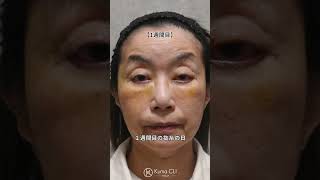 Failed to remove dark circles? Days of hell... #Dark circles treatment #Dark circles removal #Cos...