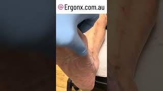 Forefoot callus removal in podiatry clinic