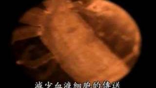 大腦的微循環退化