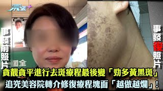 東張西望｜貪靚貪平進行去斑療程最後竟變「勁多黃黑斑」 追究美容院轉介修復療程塊面「越做越爛」!｜美容院｜去斑療程｜爛面｜李旻芳｜王汛文