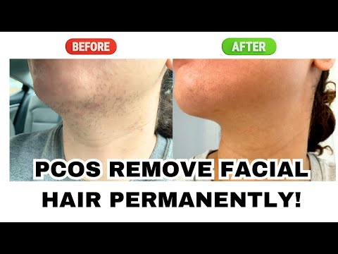 I Stopped PCOS Facial Hair Growth with THIS!