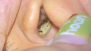 ASMR耳掃除: ゴッソリ出てくる瞬間を見逃すな👁️‍🗨️