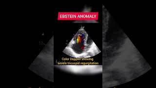 Ebstein Anomaly on Echocardiography