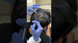 Exosomes Treatment For Hair Restoration Skinzone Medical Dr Hannah Vu MD
