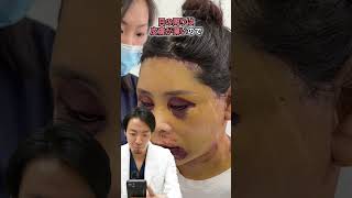 【美容整形】これって失敗？衝撃のダウンタイム！！ #shorts