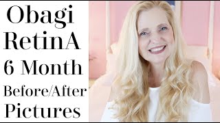 Obagi Retin-A skincare 6 month update | before and after results | Nathalie TheBeautyDiva