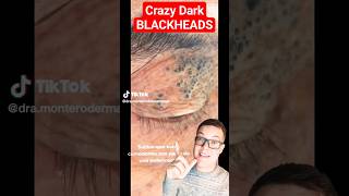 UNBELIEVABLE BLACKHEADS - Sunscreen Causes These (Lack Of) #shorts