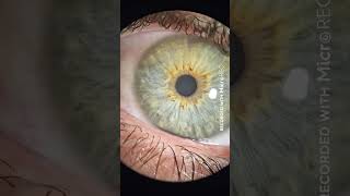 Voluntary Nystagmus - Recorded with MicroREC
