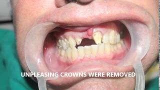 Best Smile Designing in Chennai | Dental Implants in India