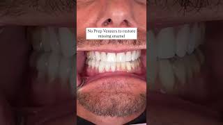 Restoring lost enamel and balancing the bite. #veneer #veneers #teethgrind #dentist #cosmeticdentist