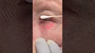 Skin Tightening - Laser Resurfacing #shorts