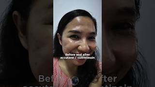 The Real Accutane Result: My Before and after transformation