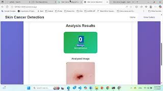 Skin Cancer Detection System!