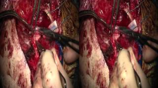 Extended Middle Fossa Approach for Resection of Spheno-Cavernous-Tentorial Meningioma