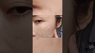 狗尾巴草点痣？别轻信，有风险！