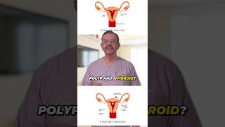 Difference between Fibroids and Polyps