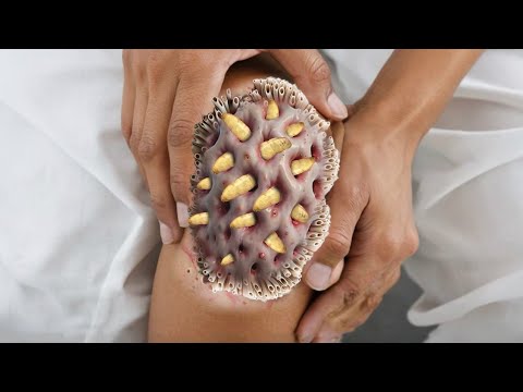 ASMR Knee Treatment Animation | Remove Big Moggot & Worm infection| Beauty ASMR 1M