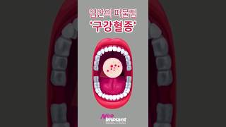 입 안에 피물집이 생기셨나요? 구강혈종 치료법ㅣ피멍울ㅣ구강건강ㅣ치아건강상식ㅣ네오임플란트