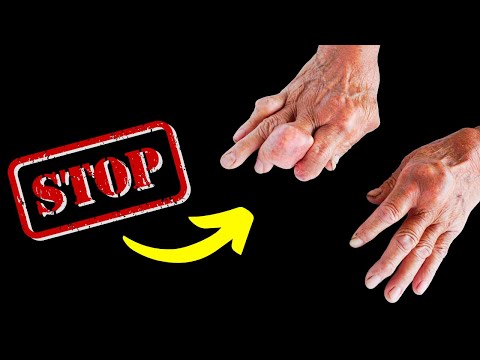 Want Arthritis Relief? Here Are 12 Foods To Skip! | 1Stop Health