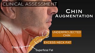 28 yo Male Chin Augmentation & Neck Lift - A Masculine Aesthetic | Aesthetic Minutes #ChinImplant