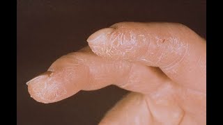 【機械工の手】手荒れは膠原病のサインだった！　＃shorts