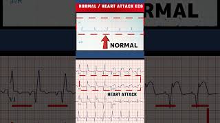 हार्ट अटैक का ECG - HEART ATTACK ECG VS NORMAL ECG#shorts