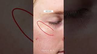Before and After IPL Laser (LUMECCA)| Kami Parsa, M.D. | PARSA MD #skincare